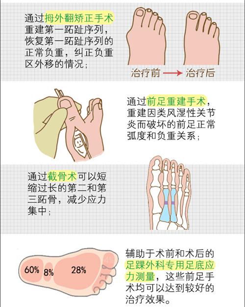 跖痛症治疗图片