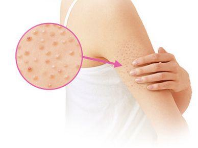 腿部如何去鸡皮疙瘩