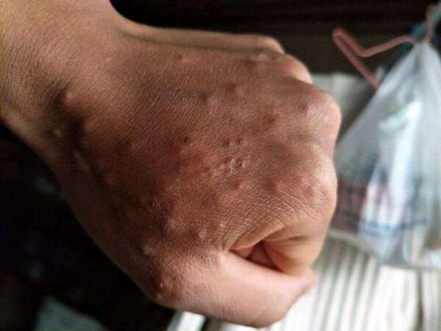 鸡皮疙瘩红点过敏
