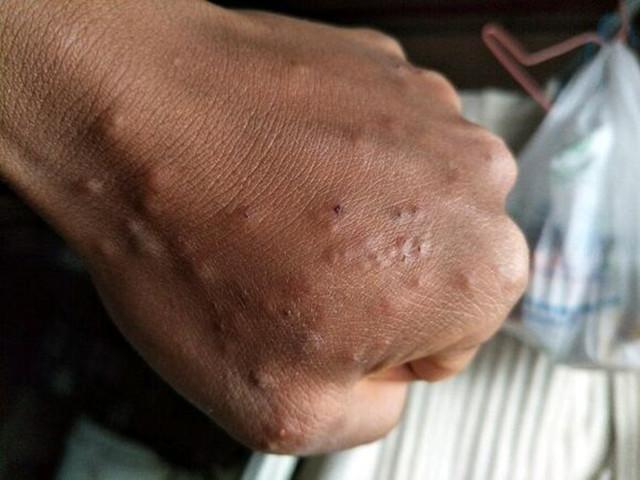鸡皮疙瘩红点过敏
