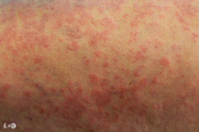 掌角化性鳞屑性红斑