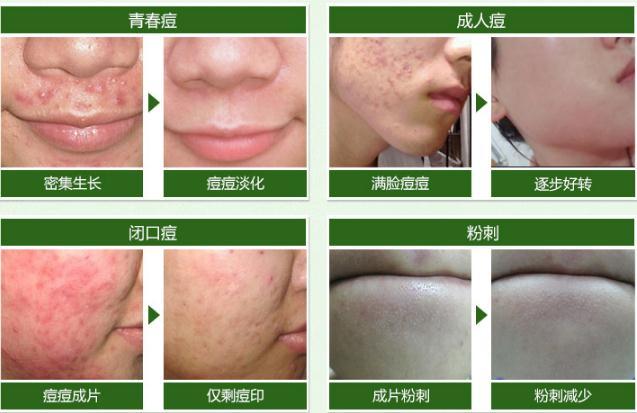 痘痘有脓怎么办