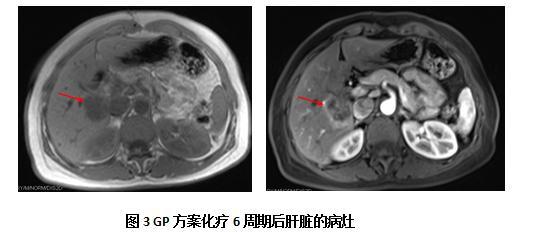 鼻咽癌非角化性未分化型治愈