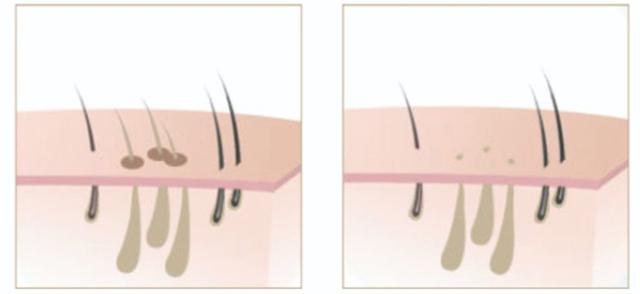 脱毛仪后毛周角化