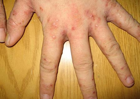 疥螨是什么原因引起的(什么是疥螨病) - 天星聚