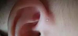 耳垂打耳洞会造成什么后果吗