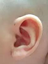 耳垂打耳洞会造成什么后果吗