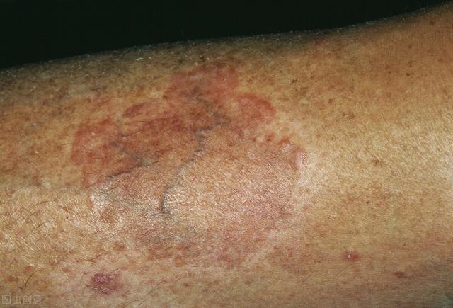 怎样观察皮肤上的糖尿病信号- 全网搜