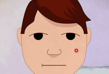 汗孔角化症能治愈吗