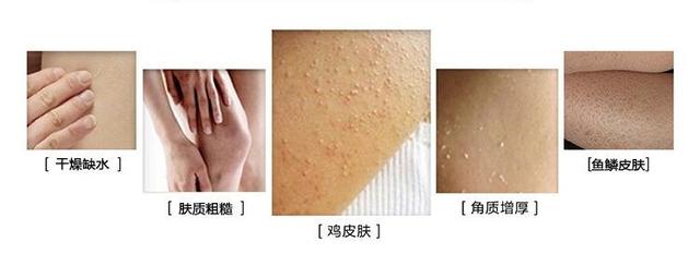 密密麻麻像鸡皮疙瘩的痘痘