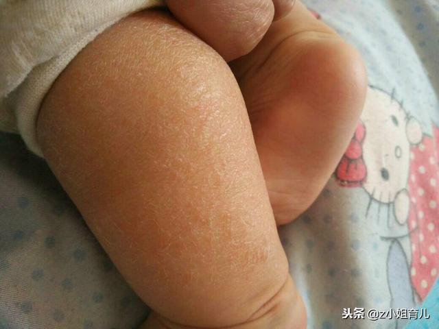 每次冬天皮肤起鸡皮疙瘩
