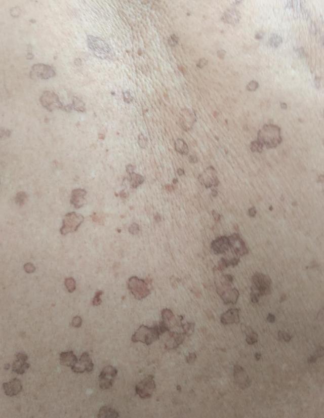 复合性汗孔角化化证