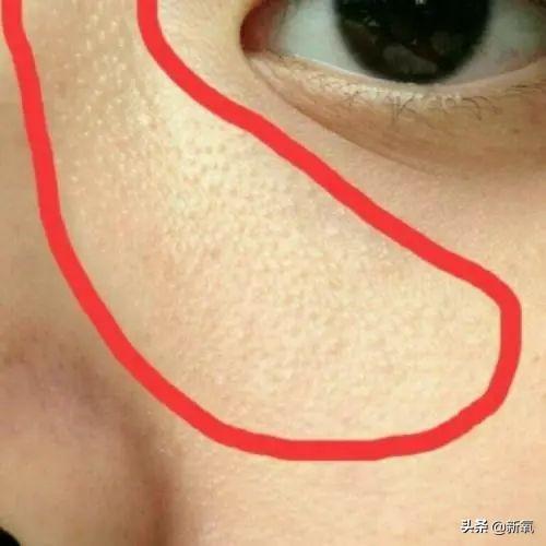 明星脸部毛周角化