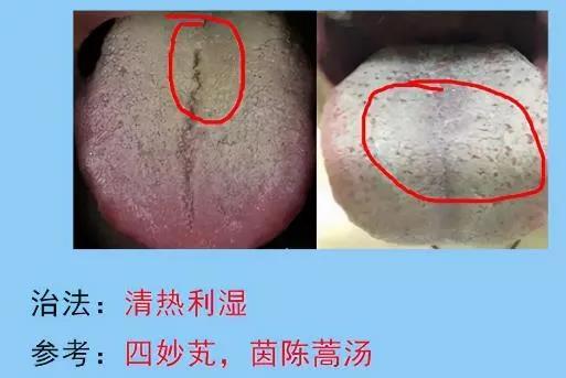 脾胃病的常见舌苔分析，脾胃不好的人要多多了解，你是图几？