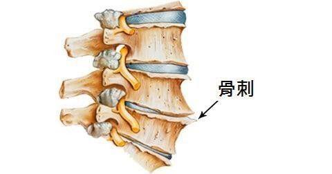 01 /頸椎骨關節炎頸椎骨關節炎的症狀表現差異很大,有些患者症狀不