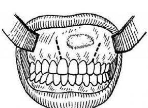 牙源性角化囊肿生长时间