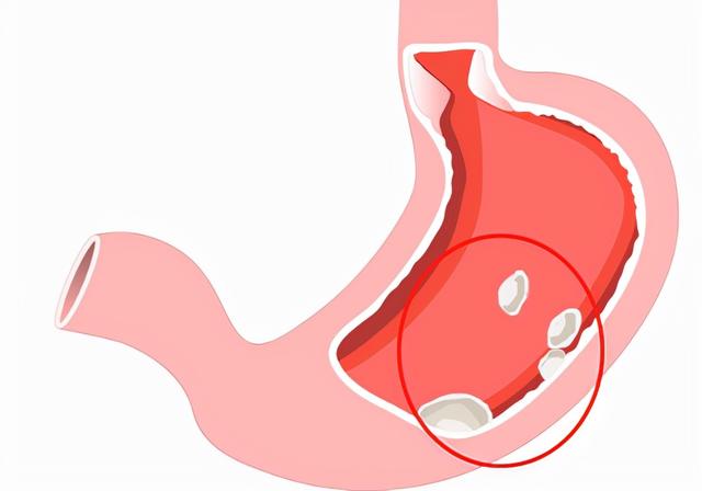 胃结石生活中常见吗？药物溶石有哪些呢？不要大量食入柿子