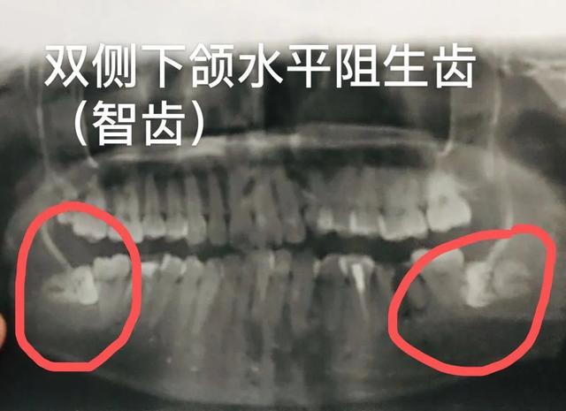 「备孕期」牙病患者需要注意这些