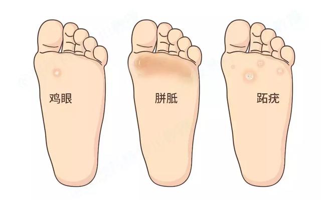 脸侧面轻微角化影响当兵吗
