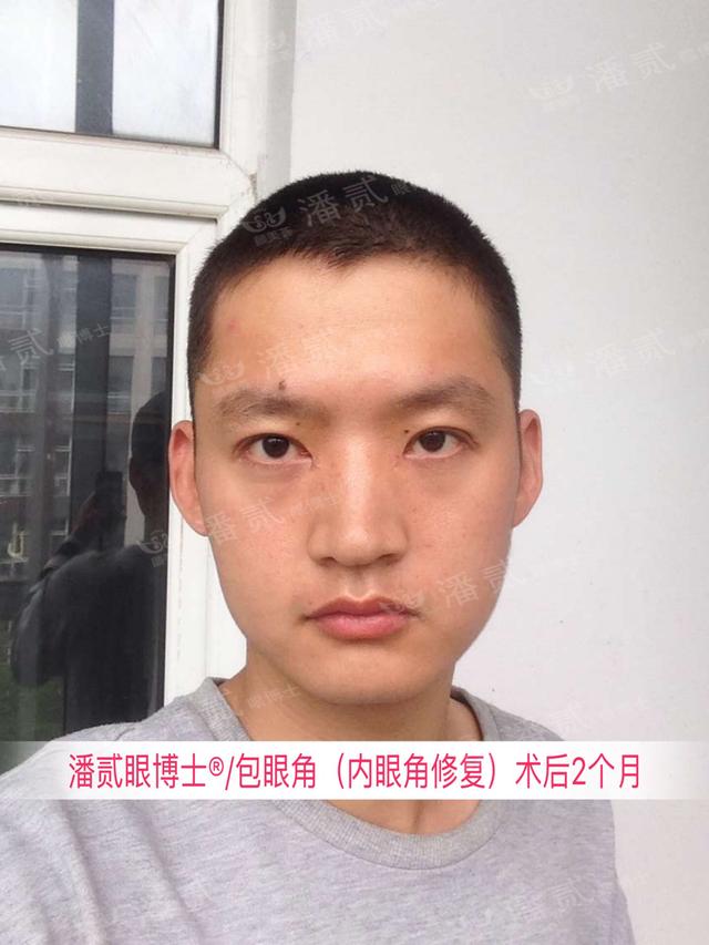 開了眼角後悔不已的案例 內眼角過大 露紅 括號 疤痕重 顯假 Kks資訊網