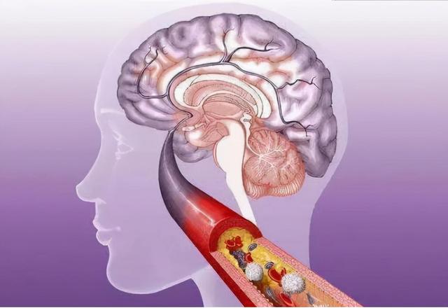 脑梗的源头已发现，却是那一些看似不起眼的食物