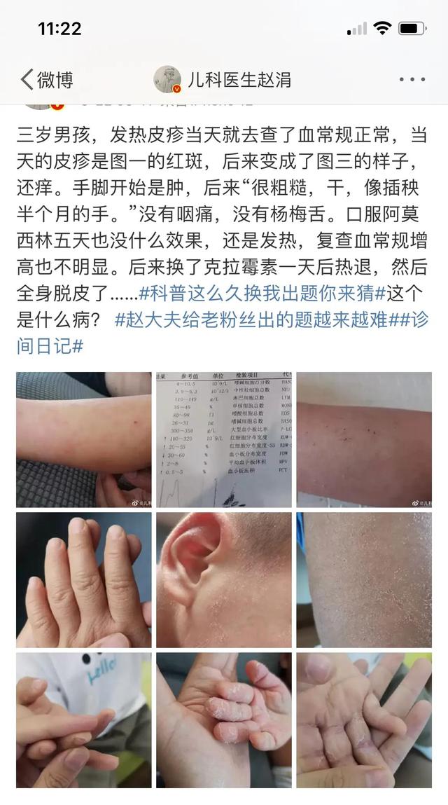 发热皮疹的孩子不少见，但这一例的诊断让人挠头