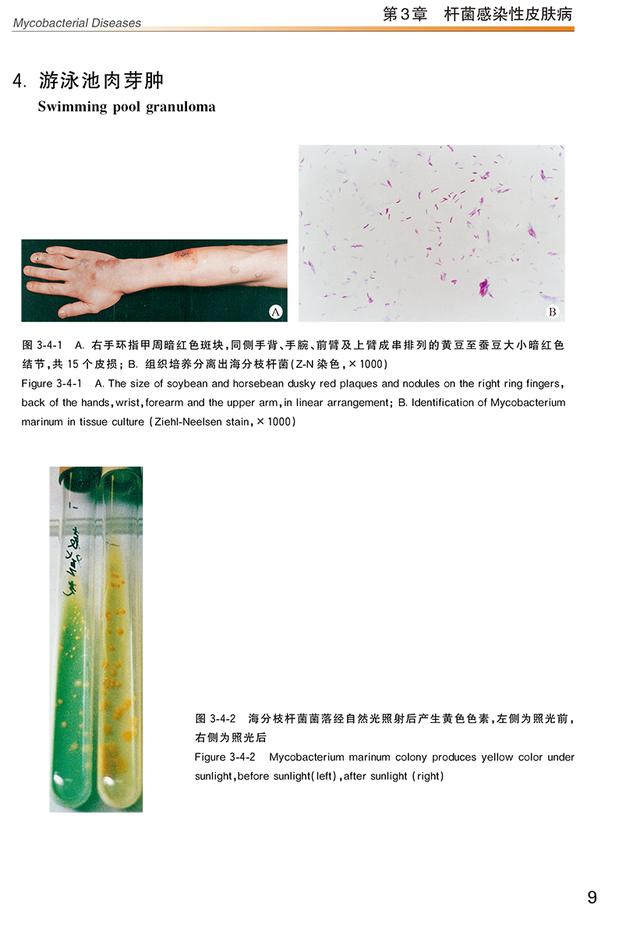 肢端角化弹力纤维鉴别