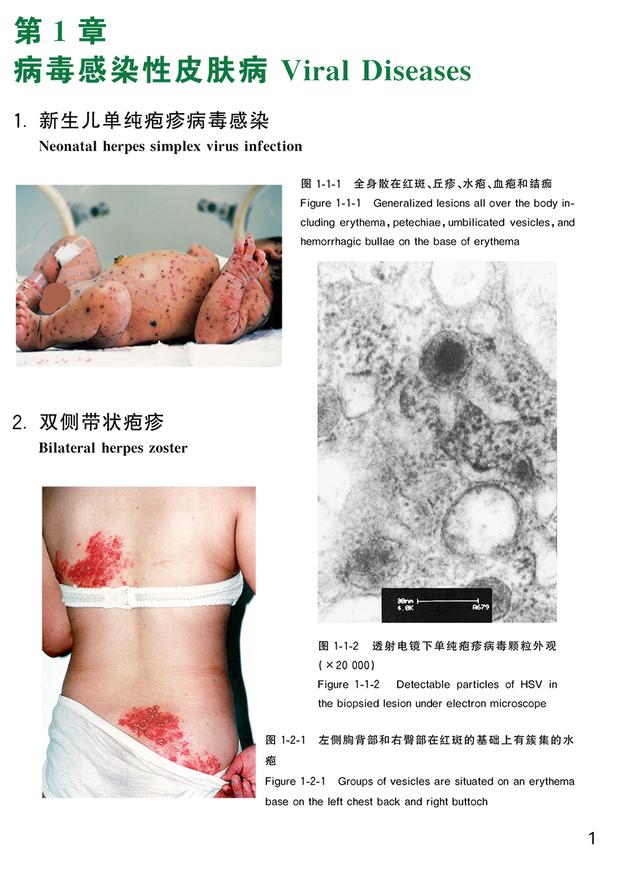 肢端角化弹力纤维鉴别