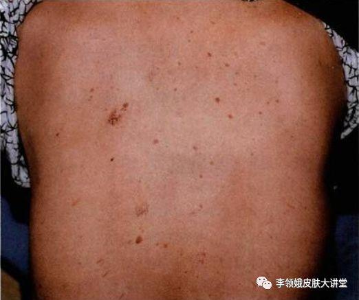 溢脂角化症图像