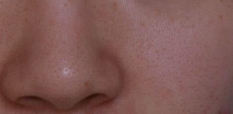 脸颊毛细血管扩张和毛周角化