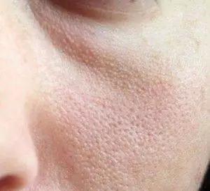 脸颊毛细血管扩张和毛周角化