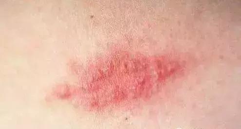 黑棘皮型脂溢性角化病