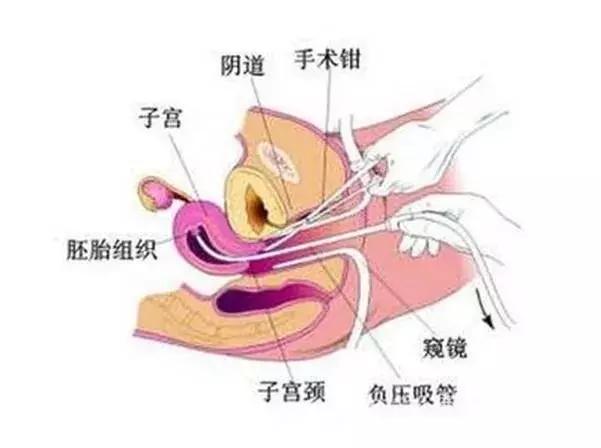 人流和刮宫是一回事吗