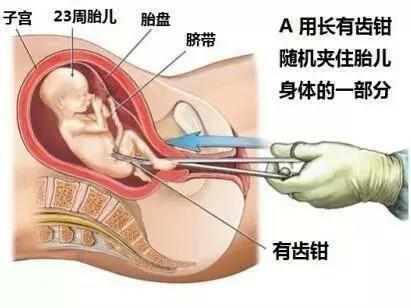 人流和刮宫是一回事吗