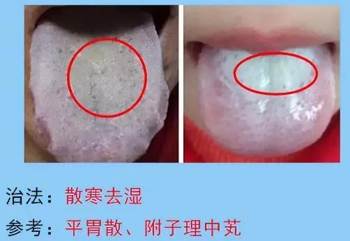 脾胃病的常见舌苔分析，脾胃不好的人要多多了解，你是图几？