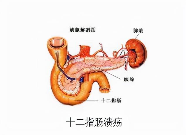 幽门螺杆菌居然会引发胃炎