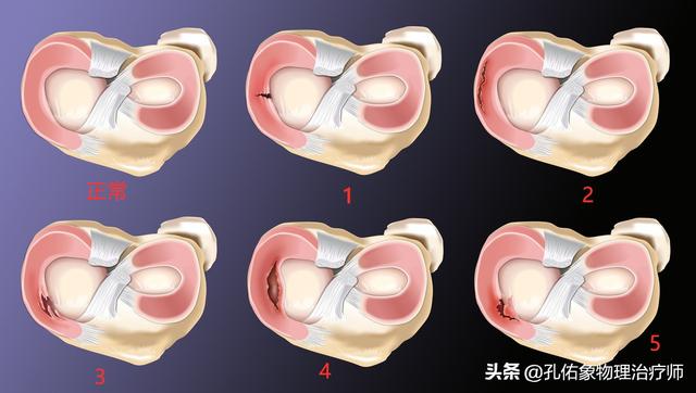 如何判斷自己的膝蓋疼痛,是不是半月板的損傷呢?