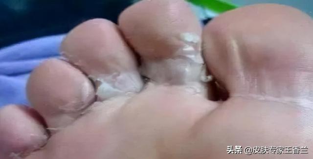 角化型脚癣最合我的治疗方法