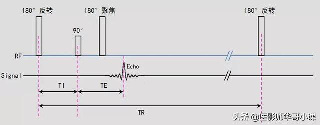 mri检查婴儿t1hi高是什么意思