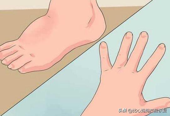 孕期水肿大揭秘！准妈妈们看这里