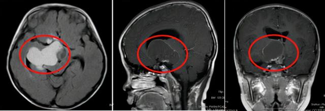 9岁男童摔了一跤 意外发现“潜伏”多年的脑瘤