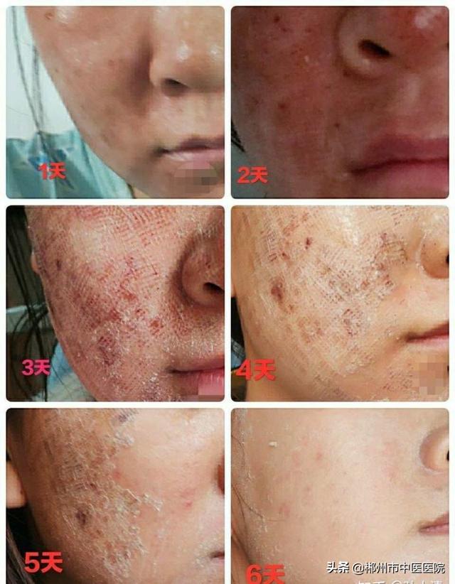 脂溢性角化病激光后留疤吗