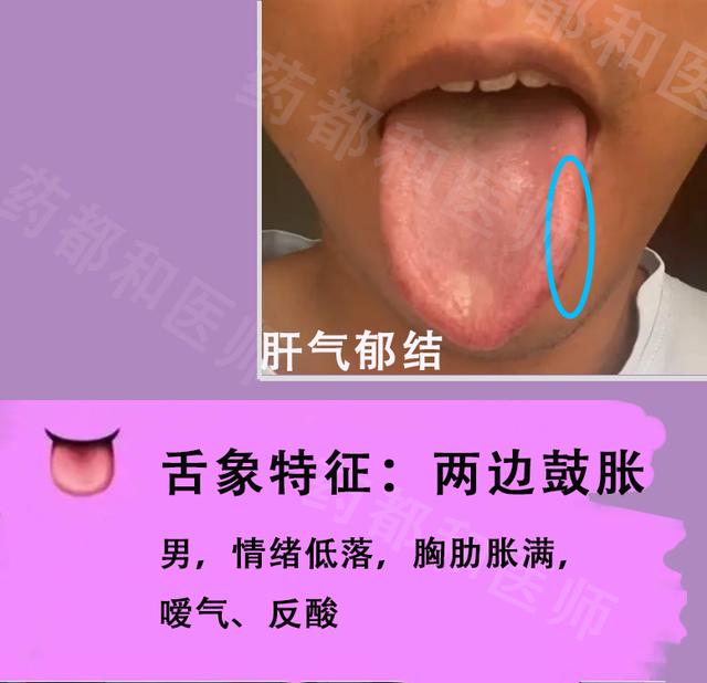 胆囊息肉，胆结石，肝囊肿？6种肝胆病变，看看舌象就知道