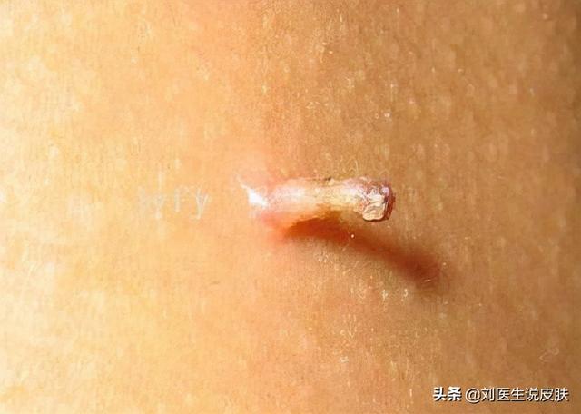 疣的种类辨别图表(皮肤长疣预示着什么病)-夏天文章网