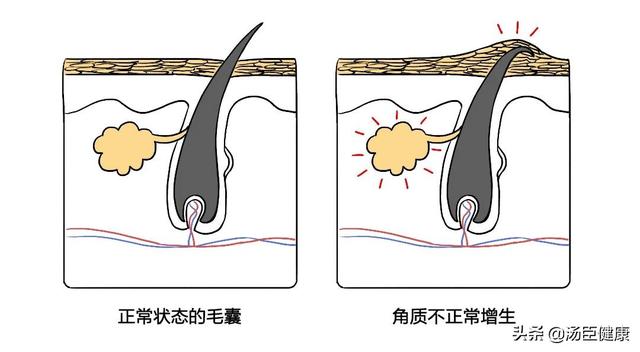 红色红点摸起来有点像鸡皮疙瘩