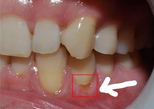 牙龈根部图片
