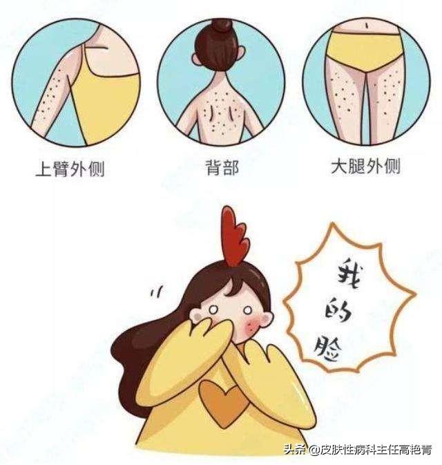 毛周角化怎样预防遗传给下一代