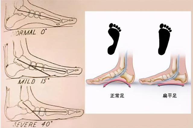 小腿不直怎么办