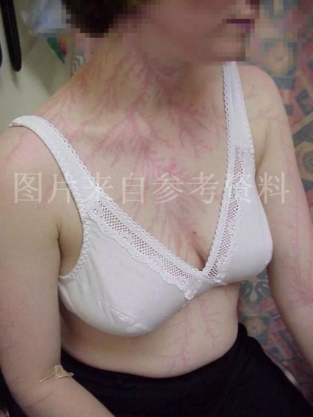 活人长尸斑活多久