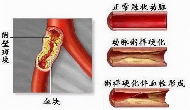 高血压、尿酸高、血糖高...6种指标多高才算病？需要吃药吗？